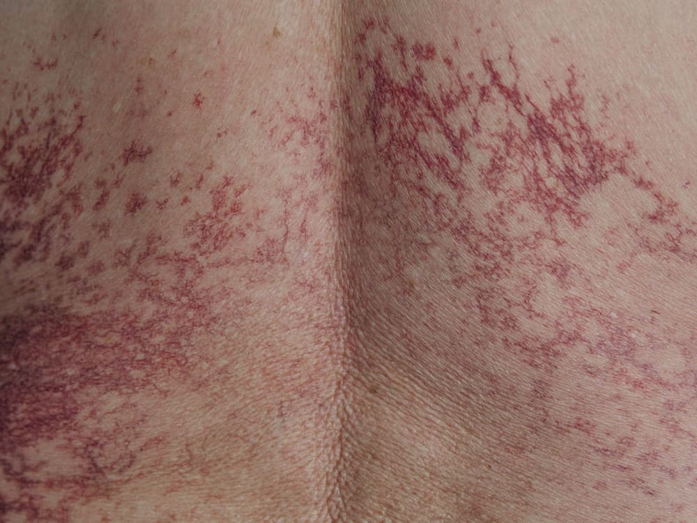 Plamica alergiczna – przyczyny, objawy, leczenie