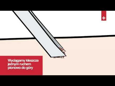 Pierwsza pomoc: Ukąszenie kleszcza