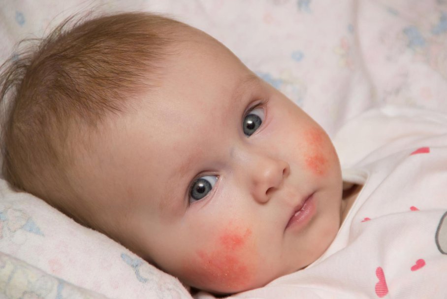 Wysypka na twarzy u dziecka – plamki, krostki, pokrzywka na buzi