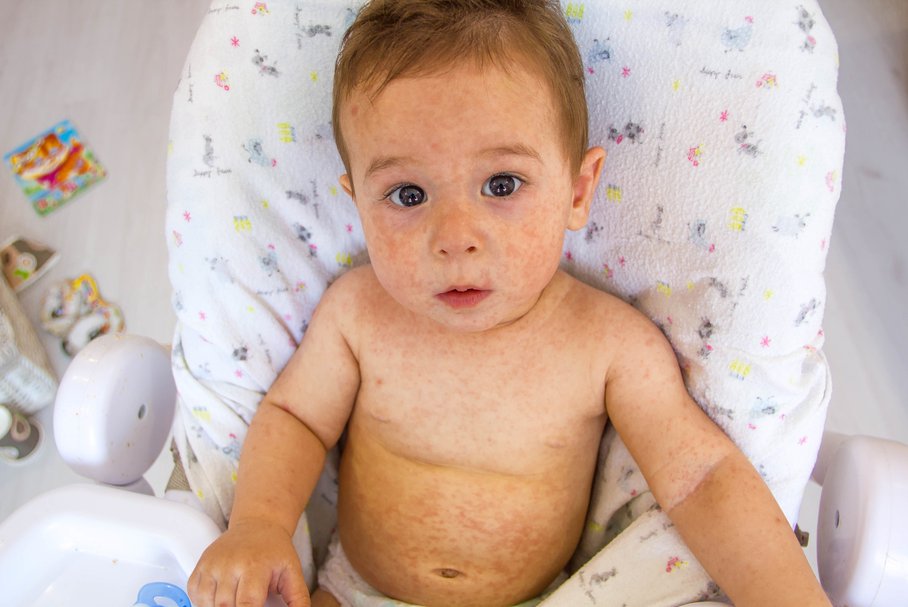 Wysypka u dziecka – jaka choroba może być przyczyną wysypki na ciele dziecka?