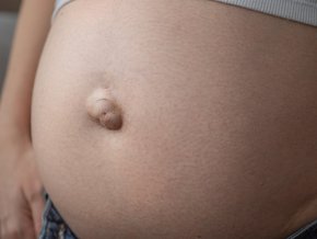 Przepuklina pępkowa u kobiety w ciąży.
