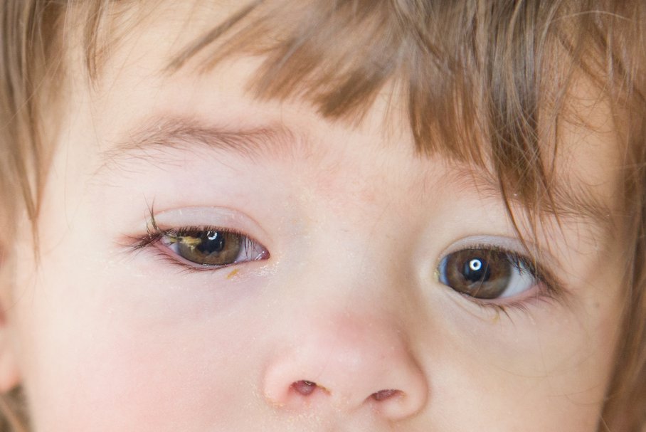 opuchnięte oczy u dziecka