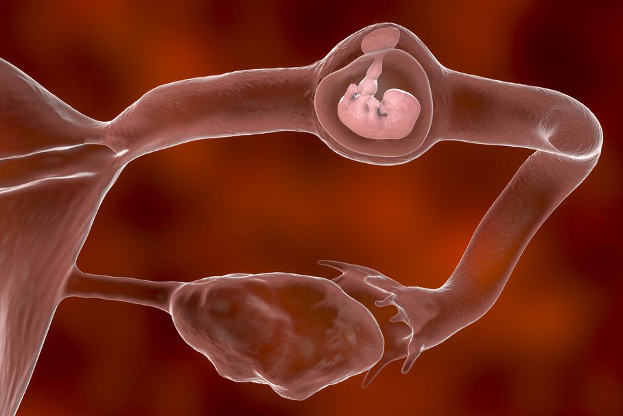 Ciąża pozamaciczna – objawy, przyczyny, postępowanie