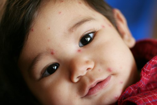 Wysypka na twarzy dziecka może być spowodowana m.in. alergią, chorobą zakaźną albo AZS.