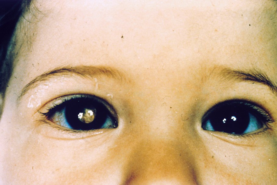 Leukokoria – jakie są przyczyny białego odblasku w oku?