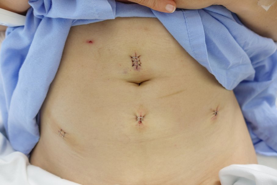 Brzuch kobiety ze szwami po zabiegu miomektomii.