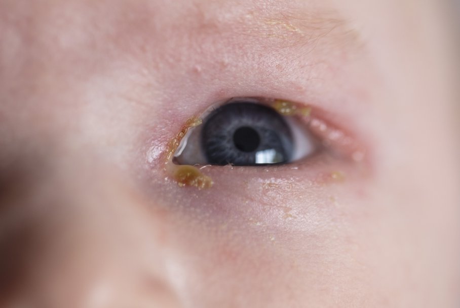 Ropiejące oko u niemowlaka – przyczyny, objawy, leczenie